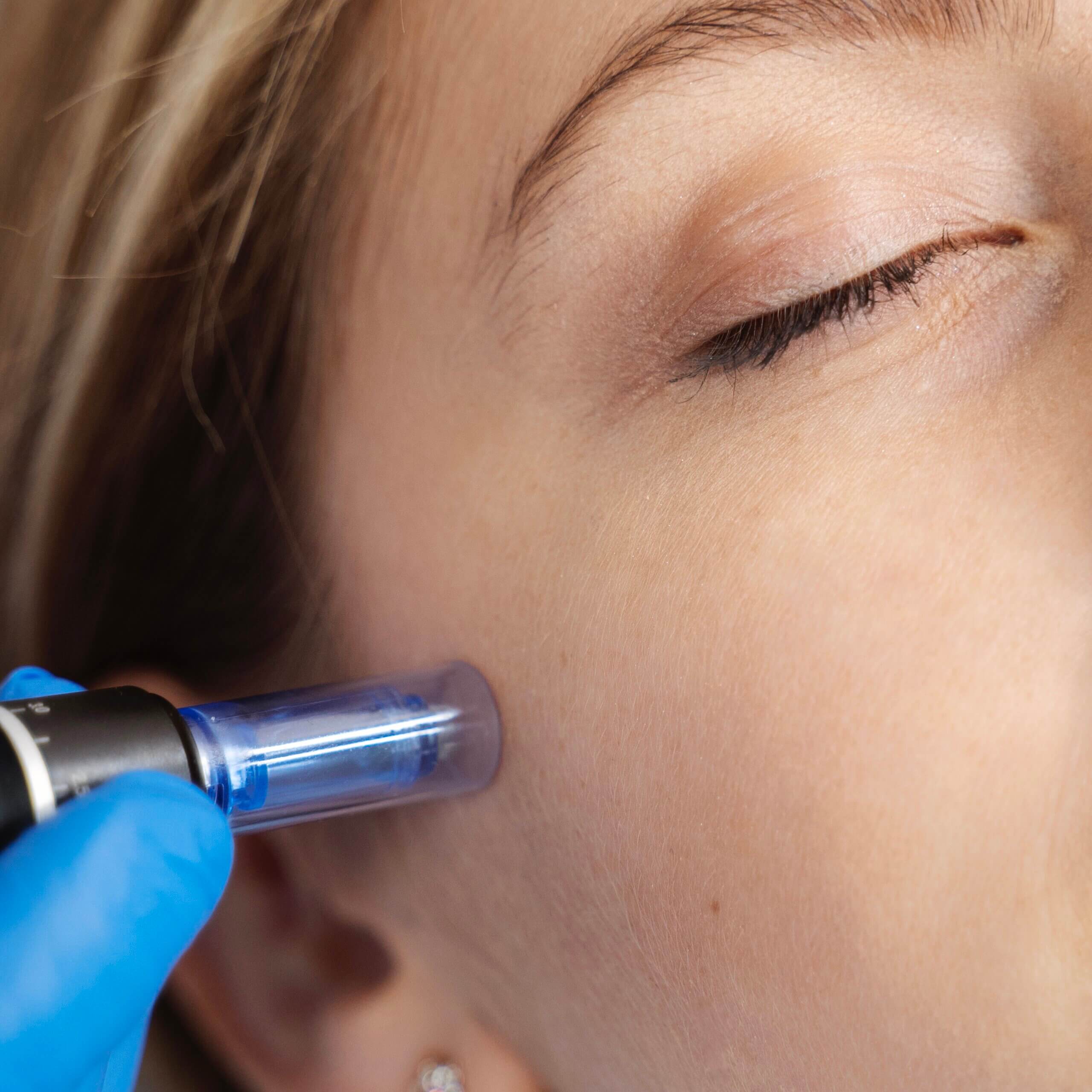 Aquafacial Intensive tiefen Reinigung